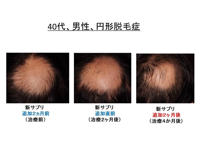 円形脱毛症　病院""